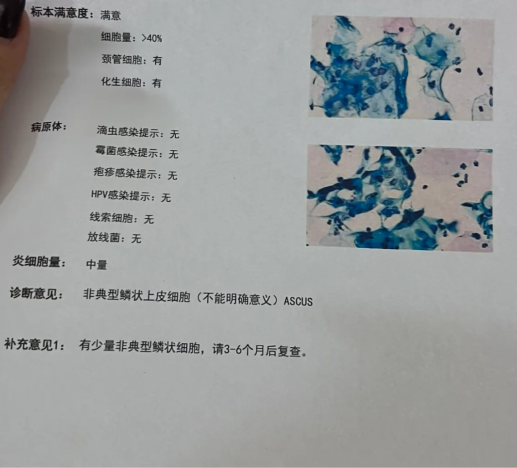 妇科检查发现鳞状细胞通常不用太担心,因为这是身体的正常细胞