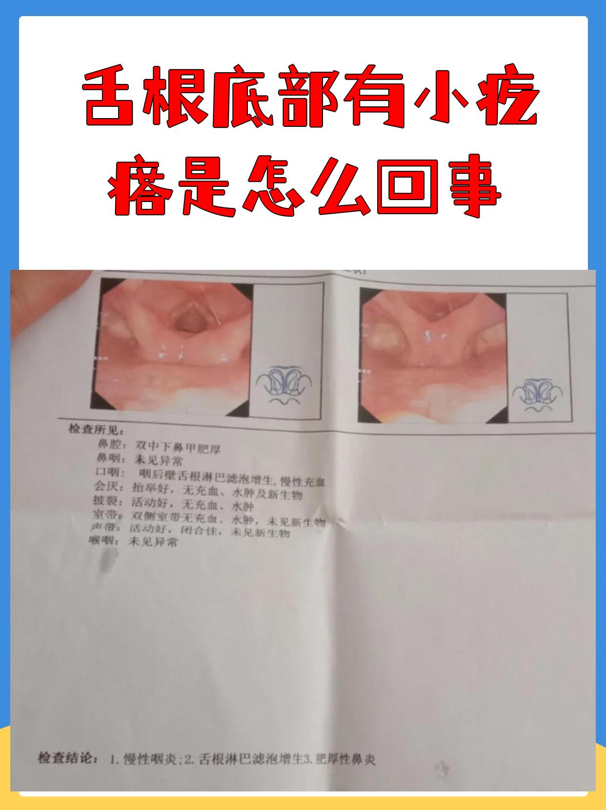 舌根底部有小疙瘩是怎么回事