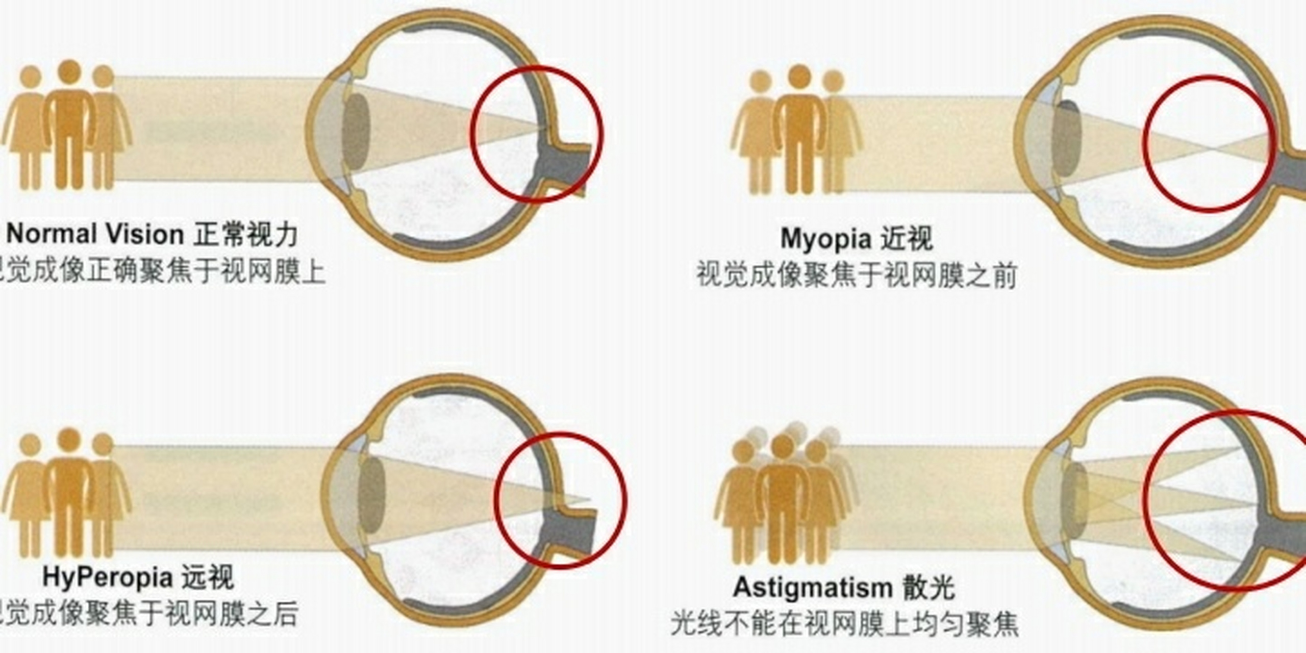 屈光不正是什么意思?