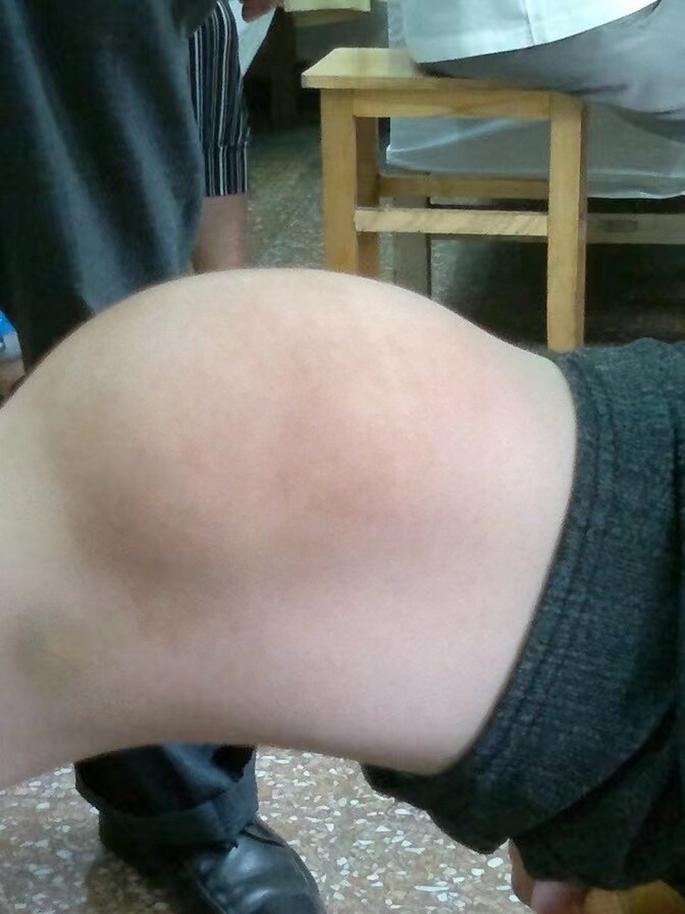 膝盖滑膜炎的症状表现 	 1,膝关节弯曲度不佳 	 膝关节伸屈困难是膝