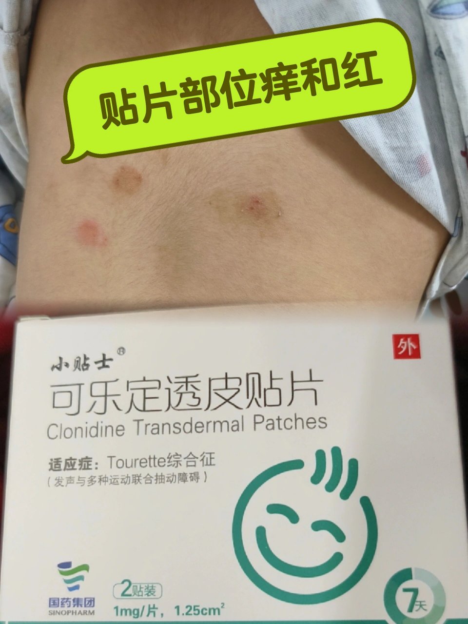 抽动症:可乐定透皮贴片暂停 可乐定透皮贴片7/1暂停 	 抽动症治疗使用