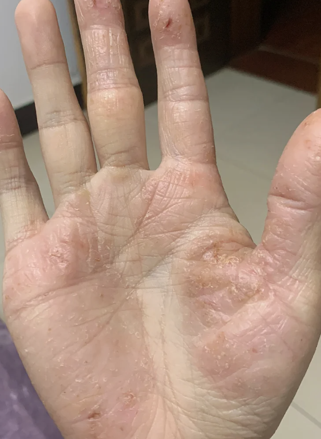手痒可能是手部湿疹,手癣或过敏性皮炎等问题引起的
