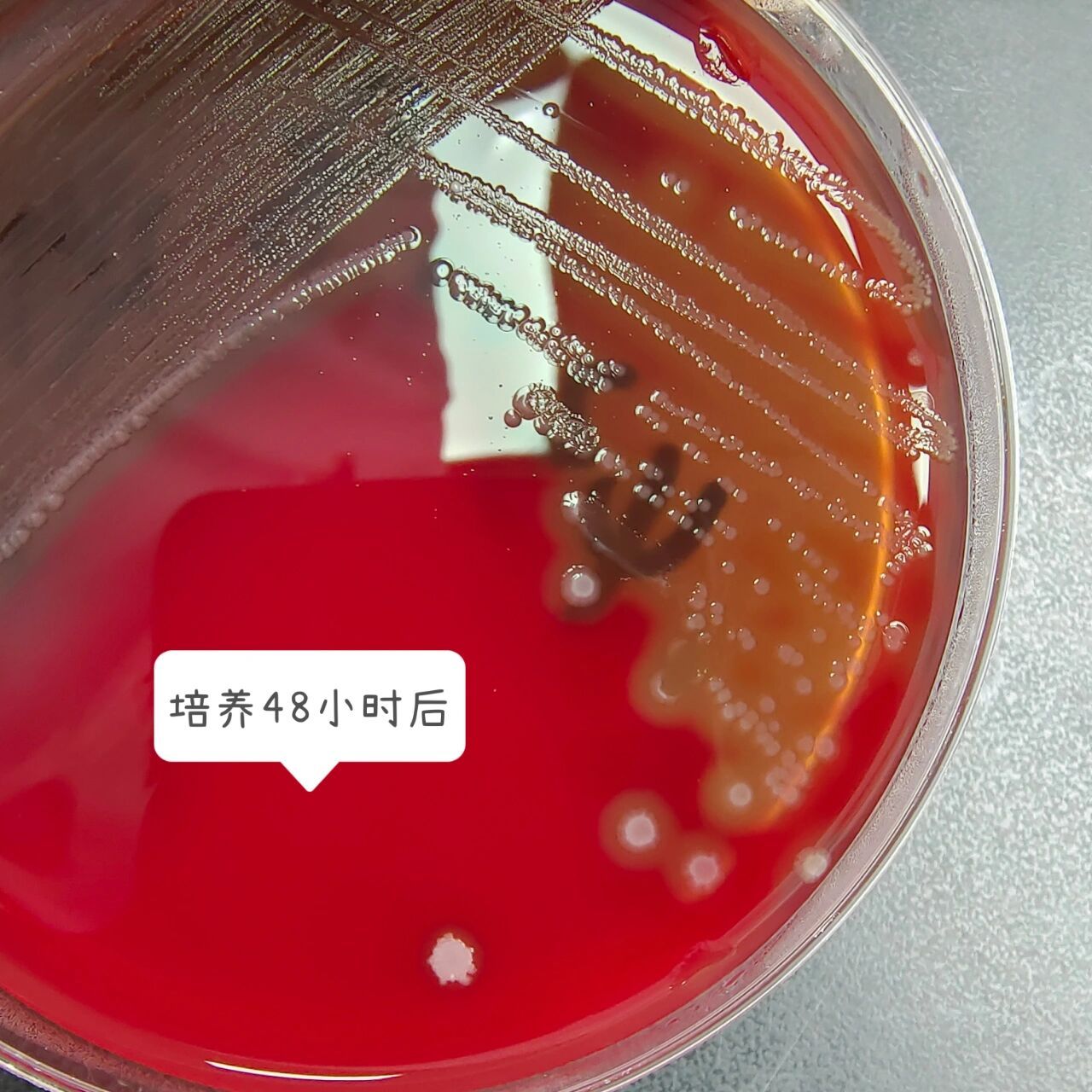 化脓性链球菌 革兰阳性球菌,单个,成双或链状排列,菌落较小,有β溶血