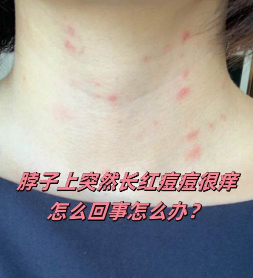 导致脖 脖子上长疙瘩是怎么回事脖子上起小红疙瘩痒是怎么回事为什么