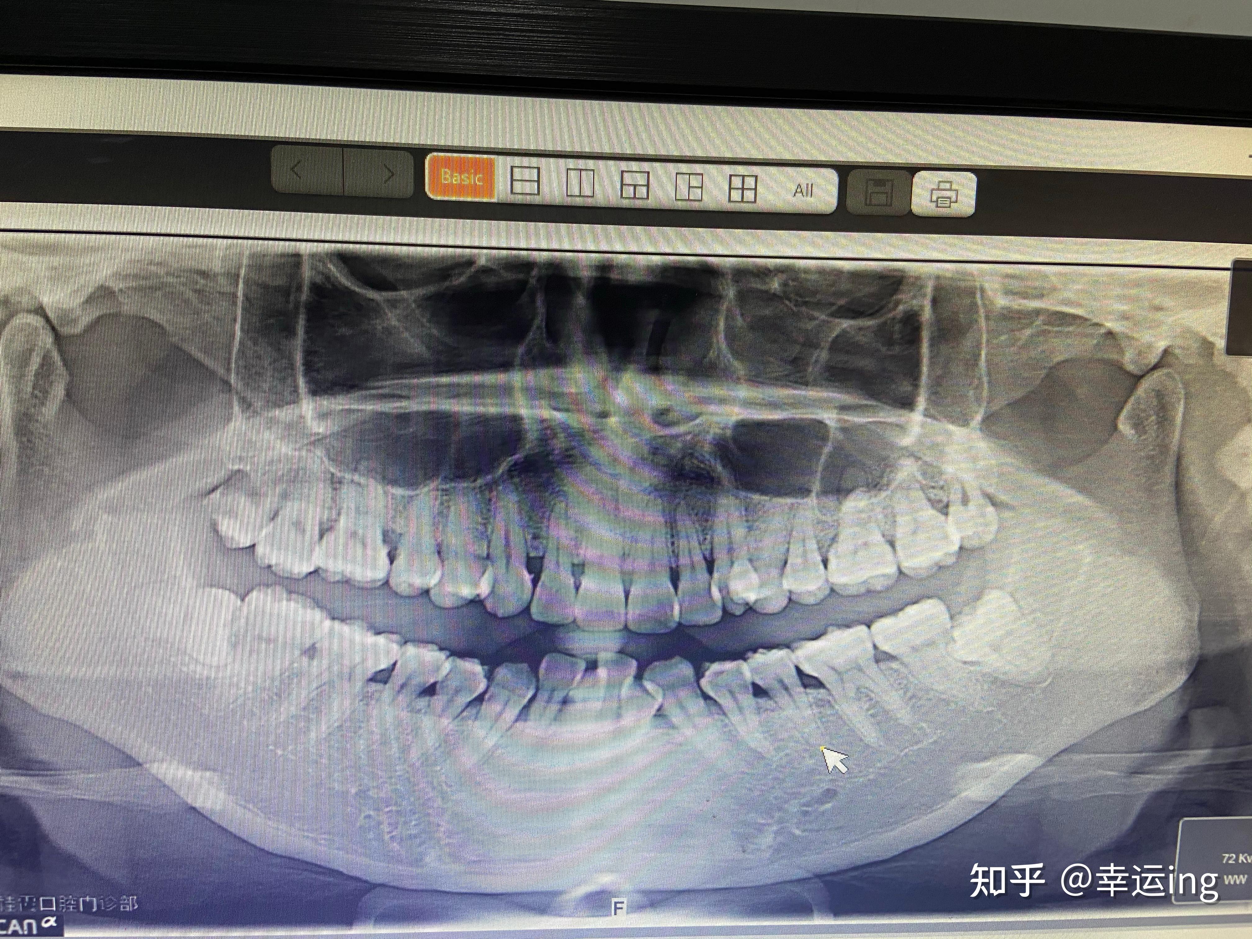 拔横着长的智齿是怎样的体验