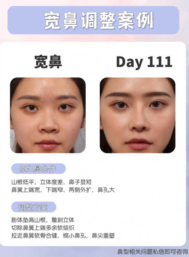 【原生鼻条件】 山根低平,立体度差,鼻子显短 鼻翼上端宽,下端窄,两侧