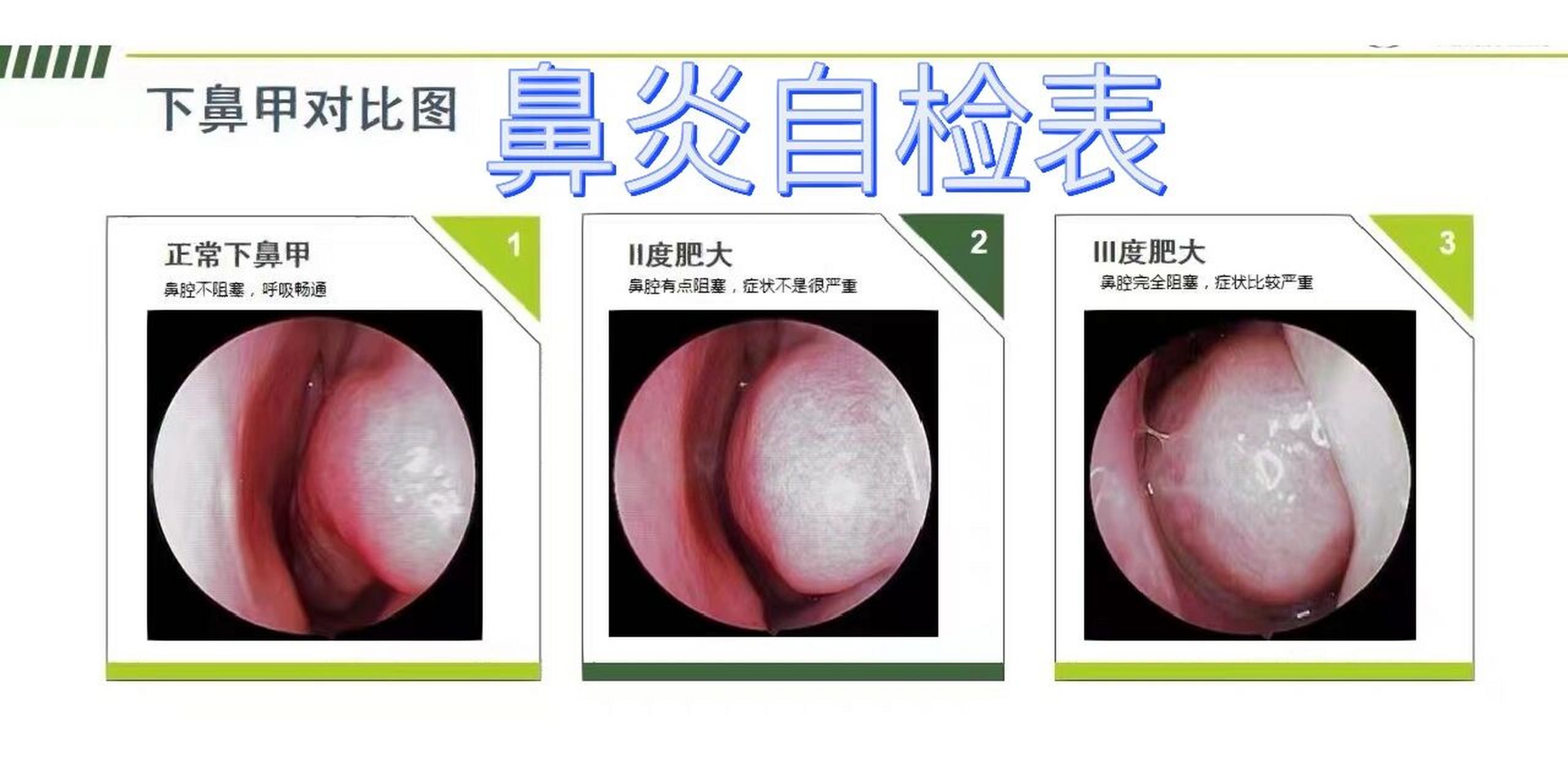 鼻甲肥大高清图正常图片