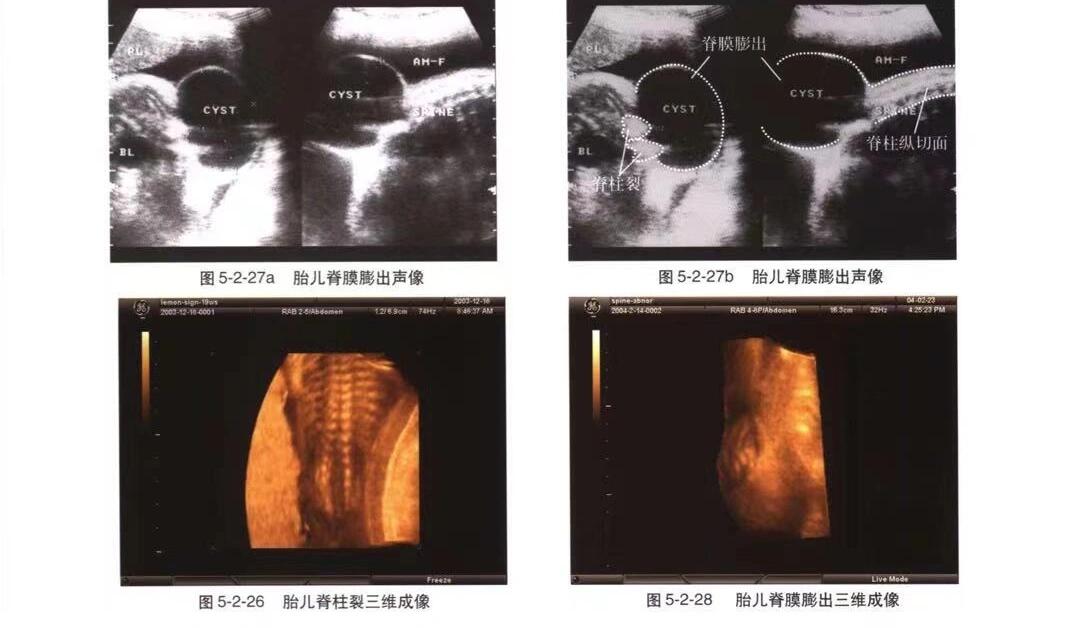 妇产科超声学习笔记6之脊柱裂和脊膜膨出