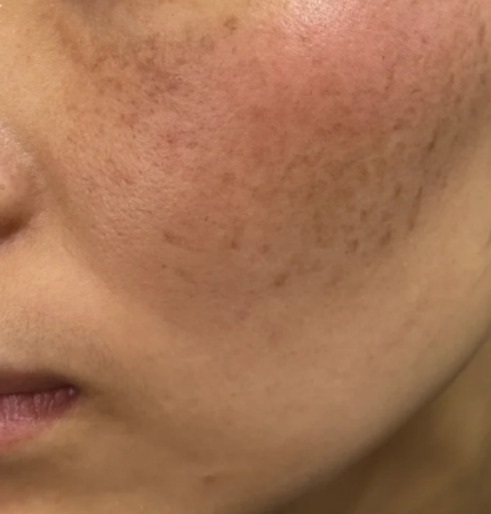 脸为什么会长黄褐斑呢为什么在线 脸为什么会长黄褐斑呢为什么在线