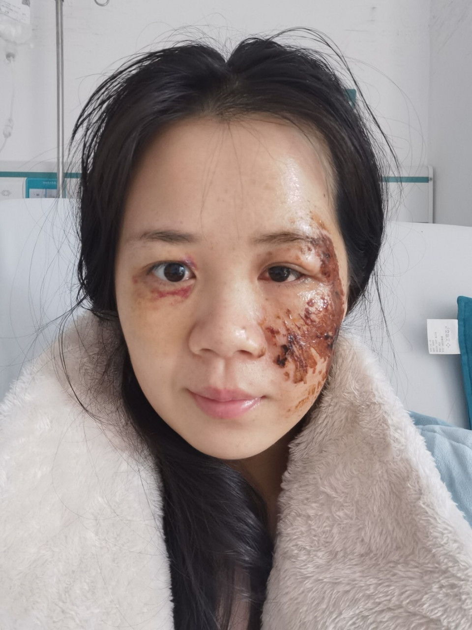 脸部擦伤第10,11天 前两天涂碘伏的次数减少,会涂抹山茶油,并且会用