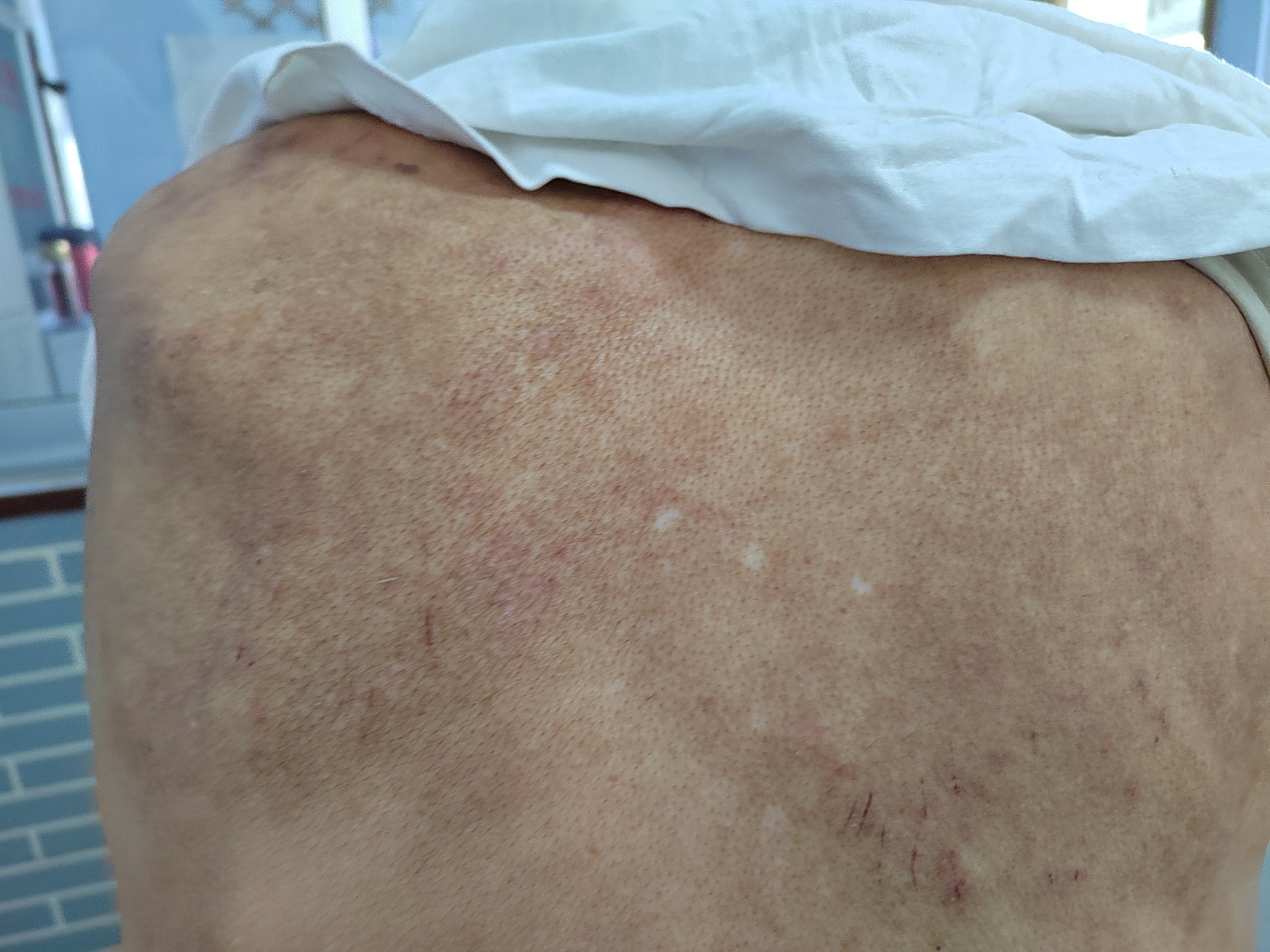 考虑特应性皮炎诊断#特应性皮炎##解决皮肤问题专注皮肤美容