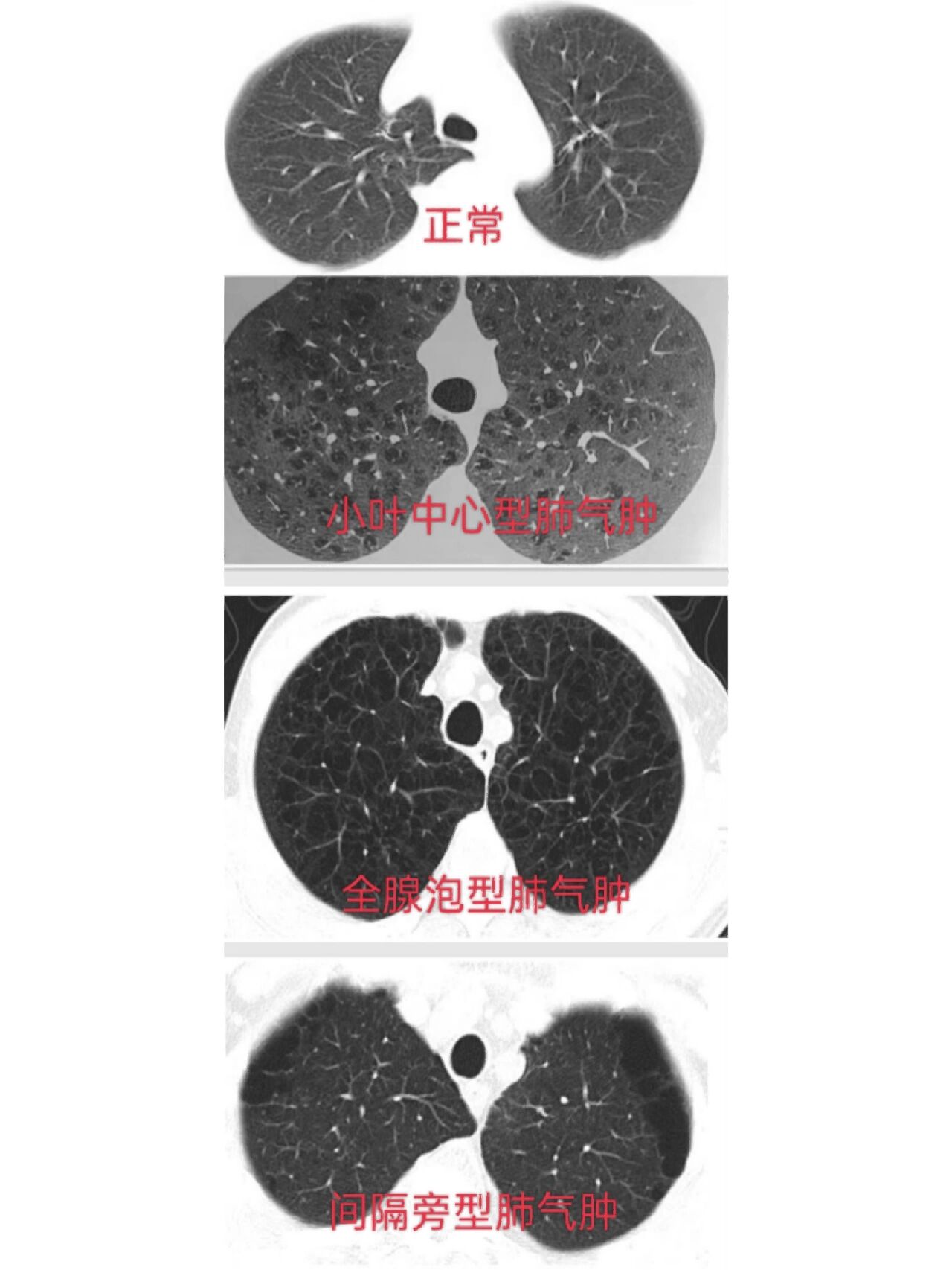 胸片气液平图片