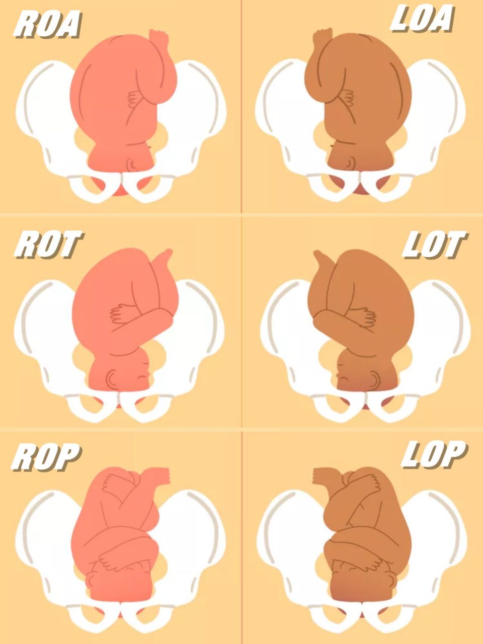 随手上一查,又搞的自己怪紧张,什么roa是最好的胎位,lot顺转剖02