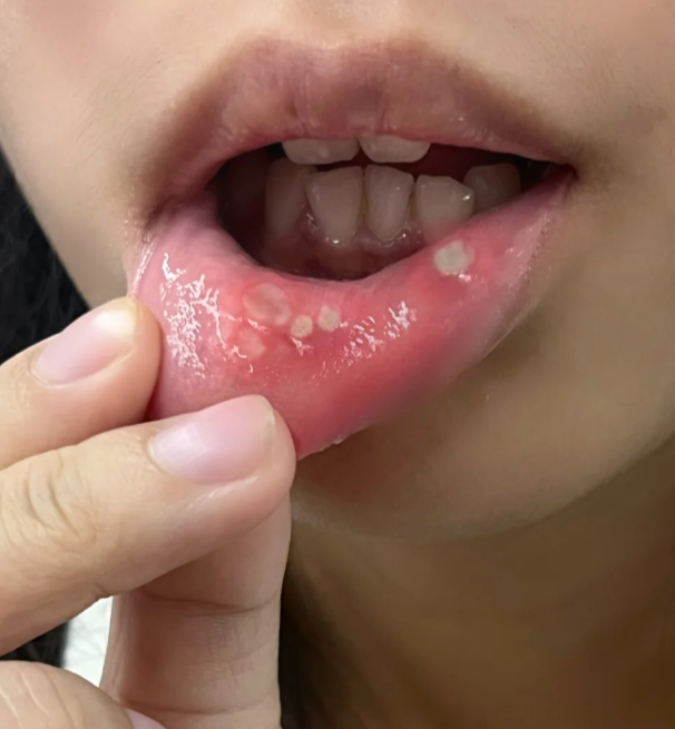 孕妇口腔溃疡可以用西瓜霜喷剂,但最好先问医生