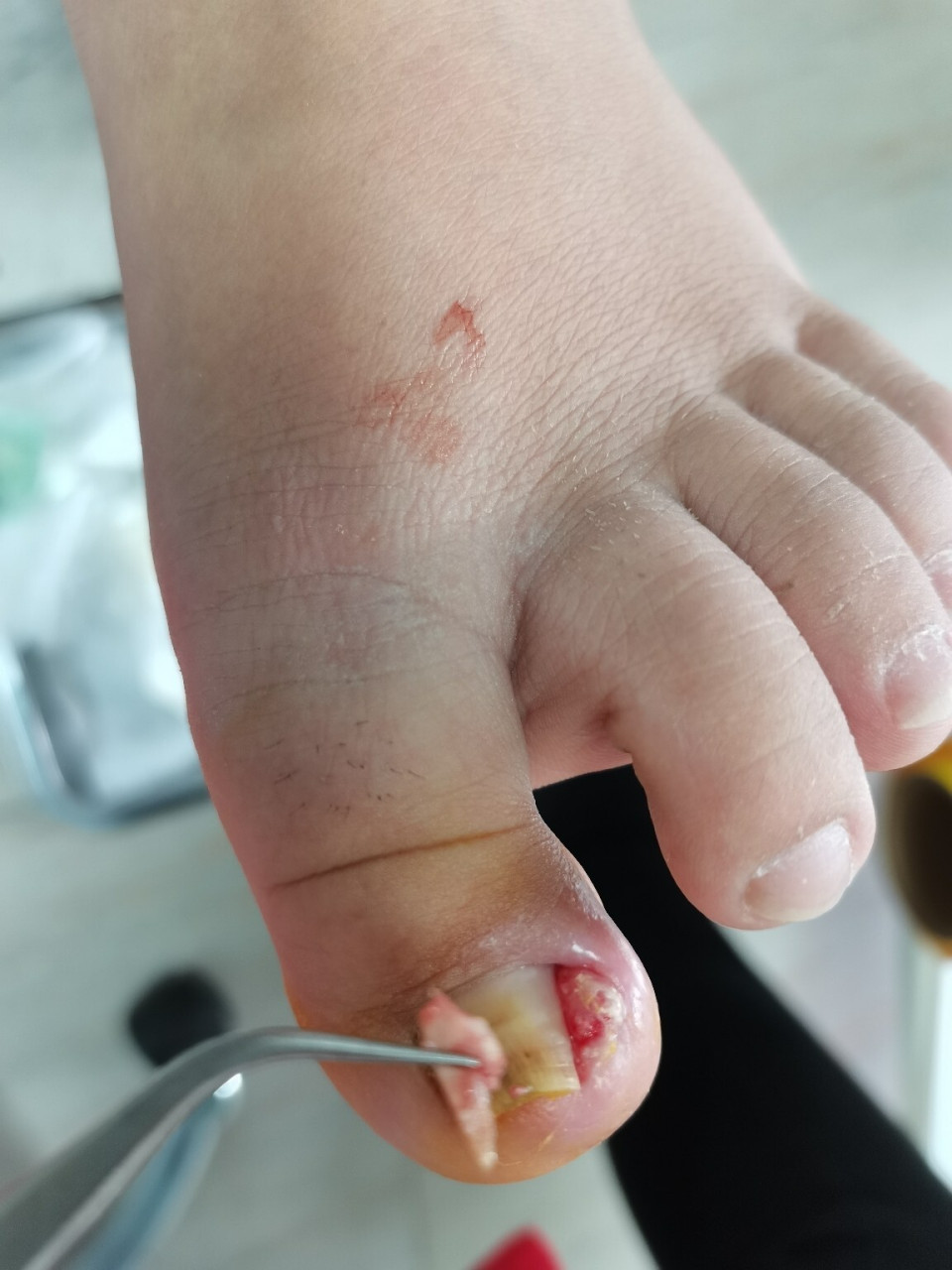 甲沟炎 上午给美女清理出来一大块扎在肉里的指甲.我看到都痛.