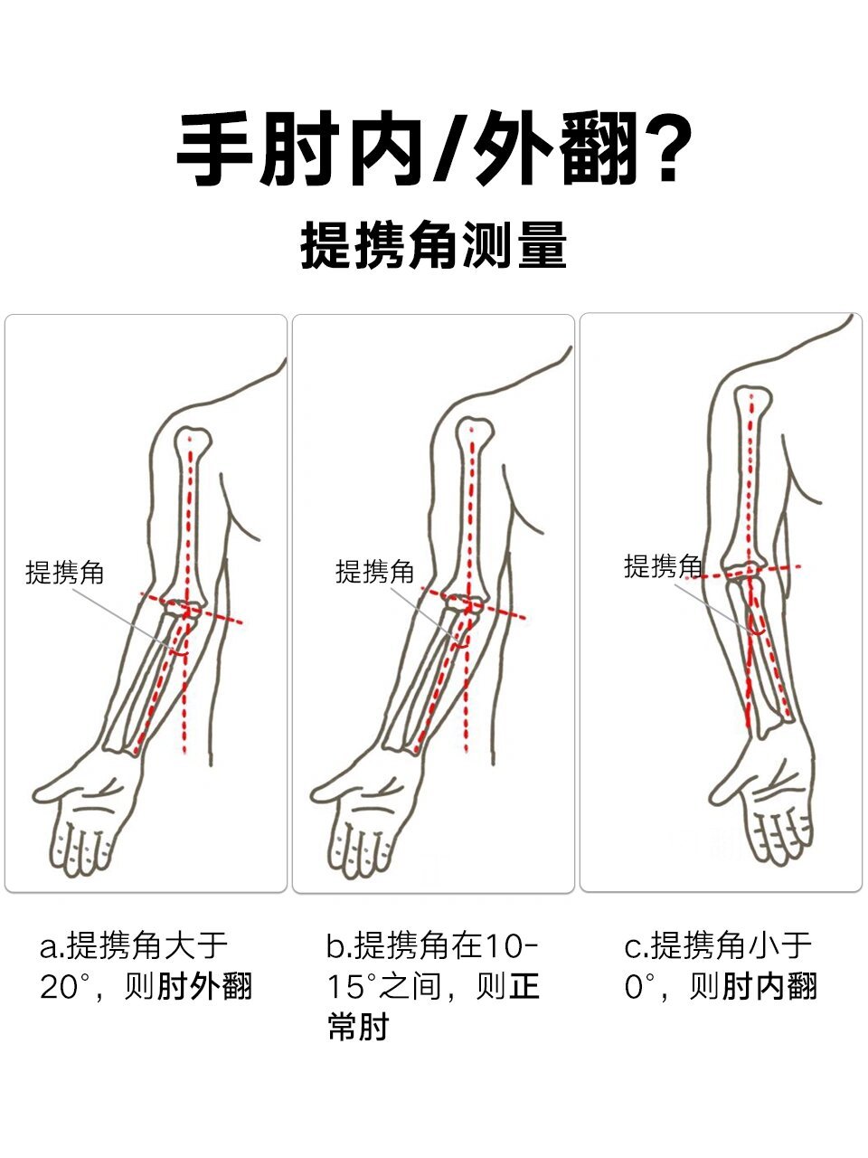 肘外翻的最佳矫正办法图片