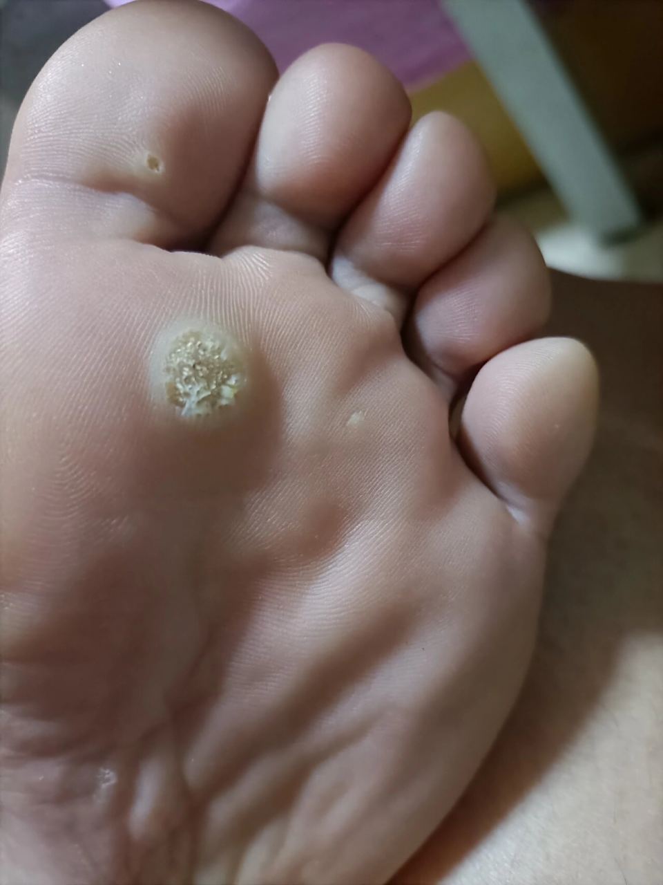 脚上有鸡眼,什么疗法最好?