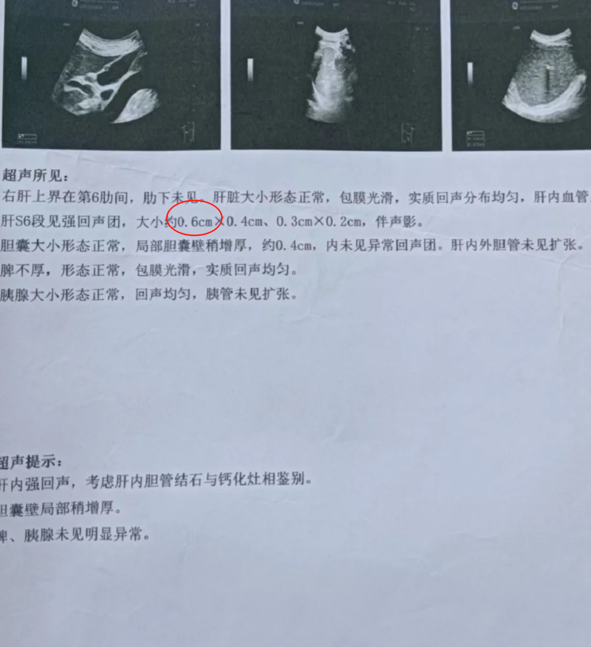 肝内胆管结石0.6cm是否严重要看有没有出现梗阻