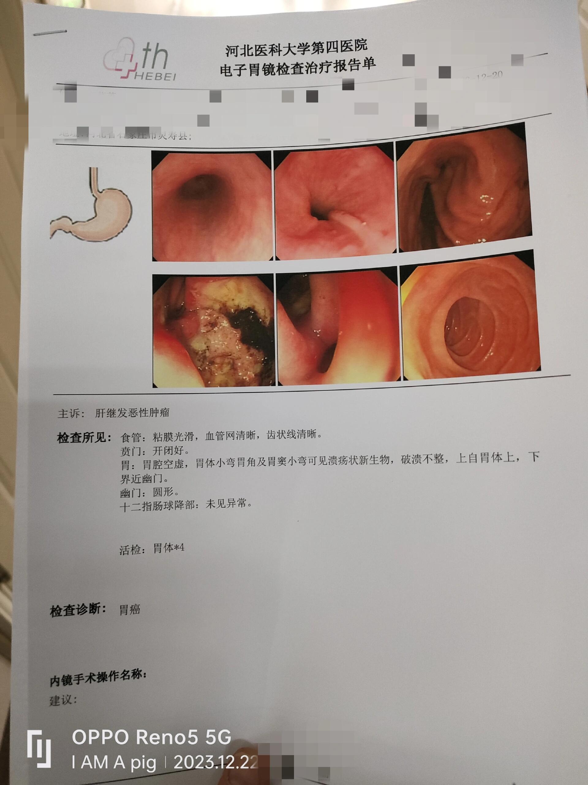 胃体小弯低分化腺癌图片