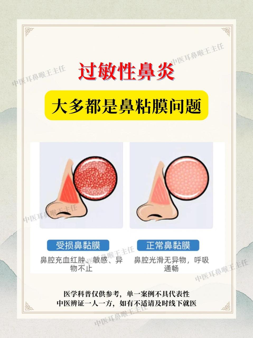 鼻炎过敏性鼻炎,大多是鼻粘膜的问题75