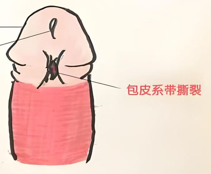 系带撕裂指的是阴茎系带这个部位发生撕裂