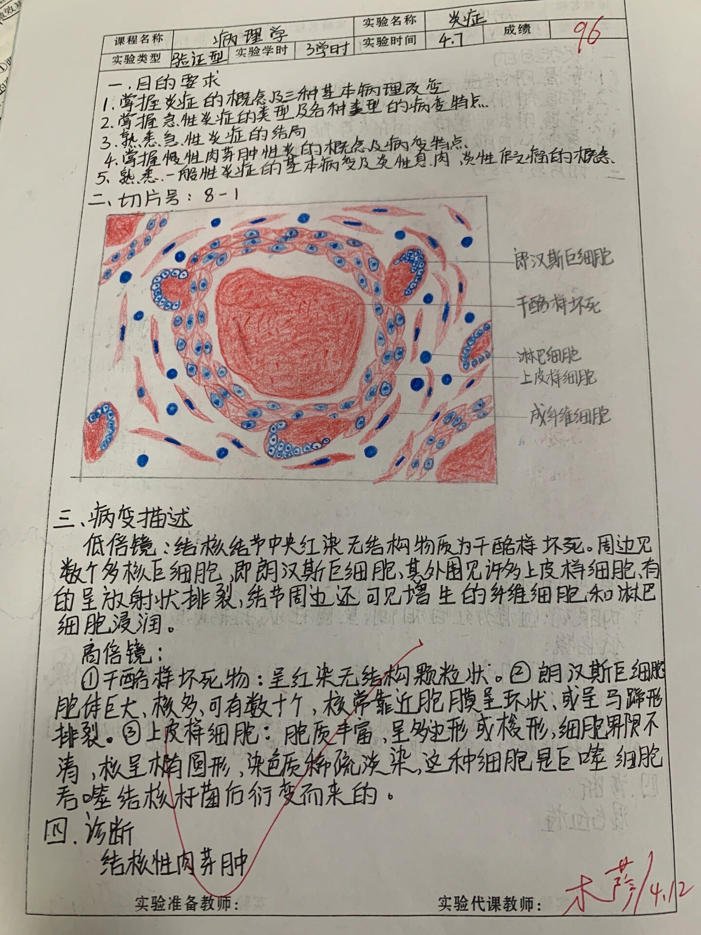 结核性肉芽肿