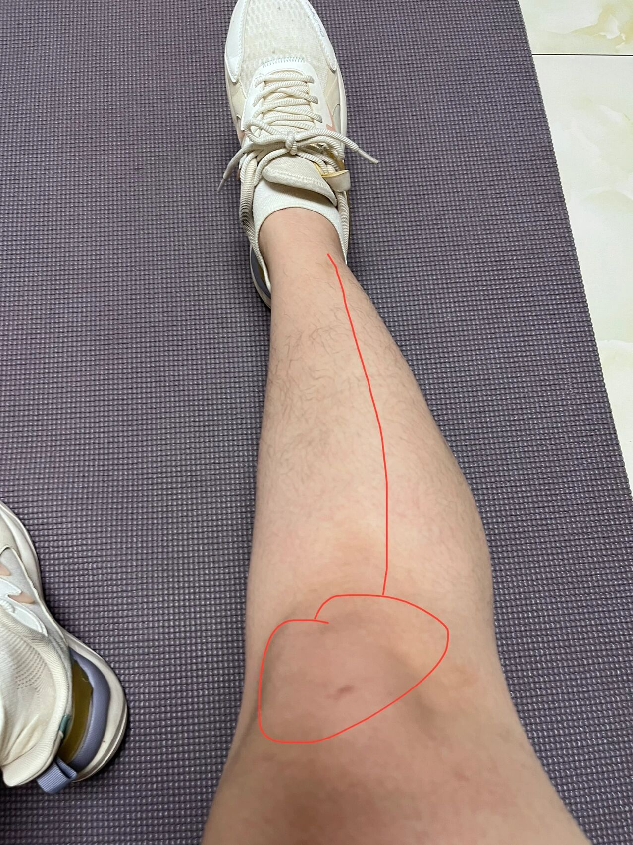 小腿骨头和膝盖不在一条线上是什么问题 刚刚发现我小腿骨头和膝盖不