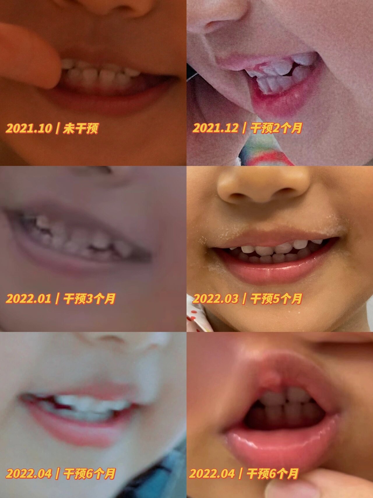 一岁宝宝发现地包天要怎么做?