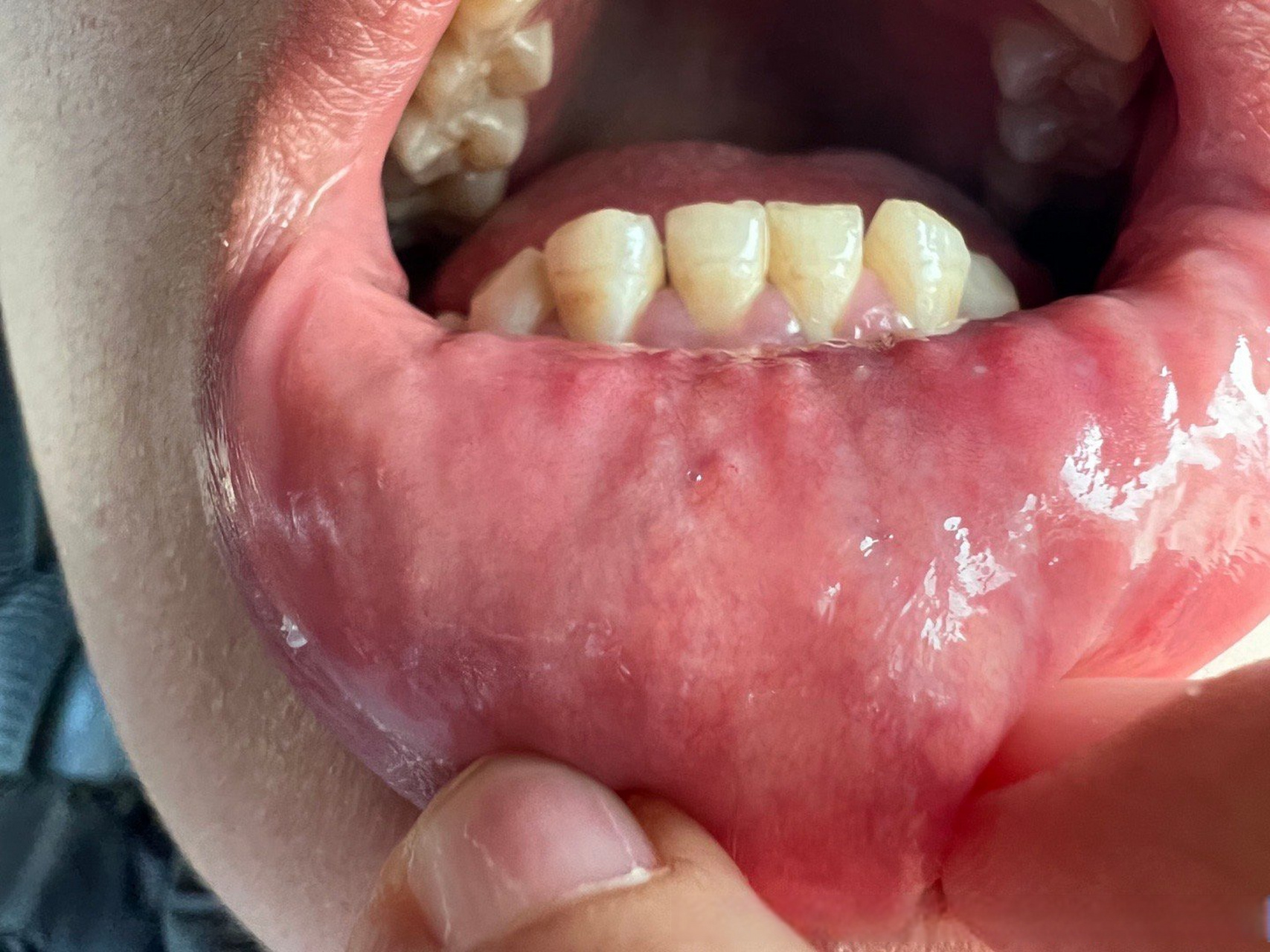 口腔里的这些白点是不是hpv感染,是不是尖锐湿疣?