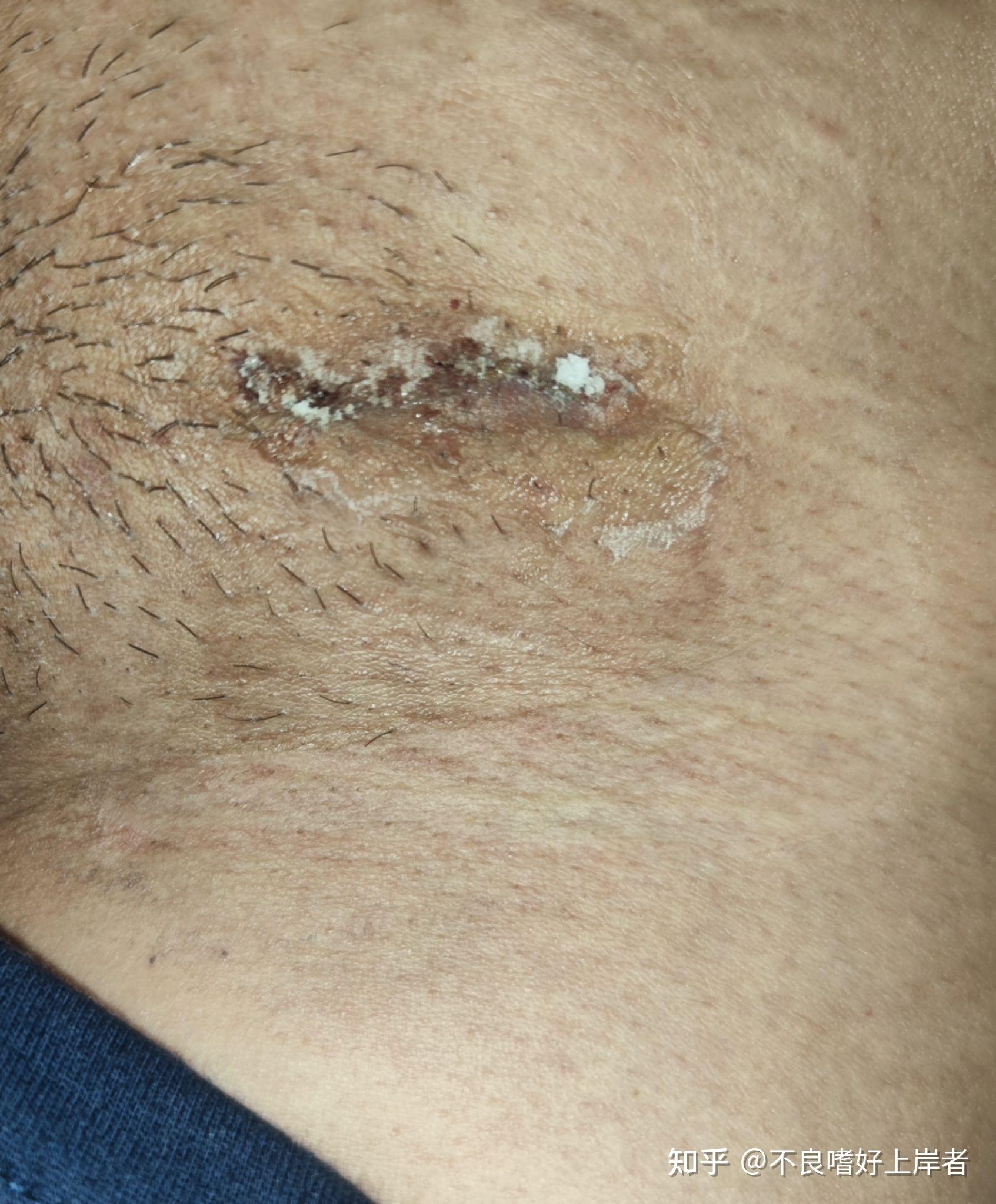 关于精索静脉曲张手术记录全过程