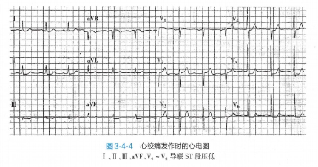 心绞痛发作心电图图片