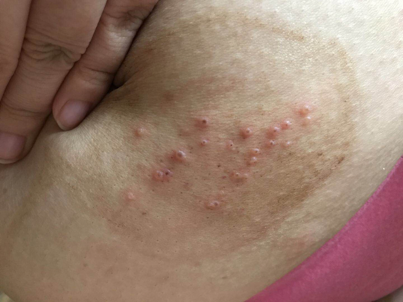 带状疱疹(胆小勿入)痊愈过程 2018年我得了带状疱疹,主要在腰腹部,刚