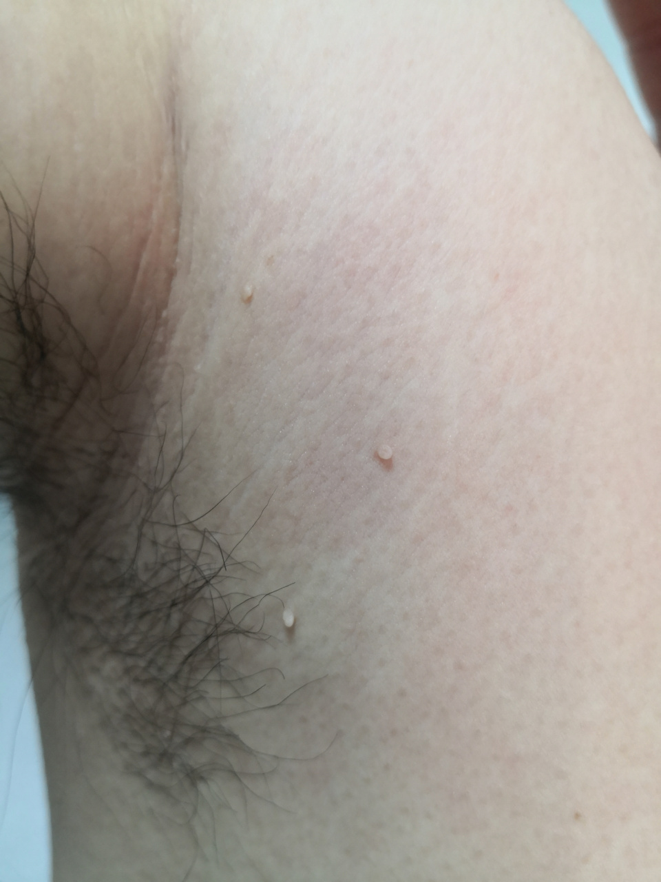 腋下的皮赘症状#皮赘