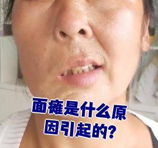 面瘫也叫面神经麻痹,主要表现是面部表情肌运动功能出现问题