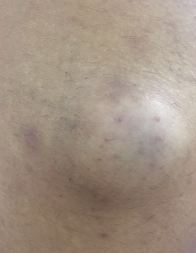 月经期间免疫力下降,容易感染细菌病毒,屁股长包常见原因有三种