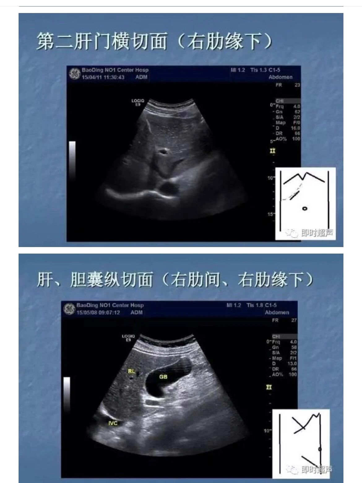 超声腹部切面之肝脏