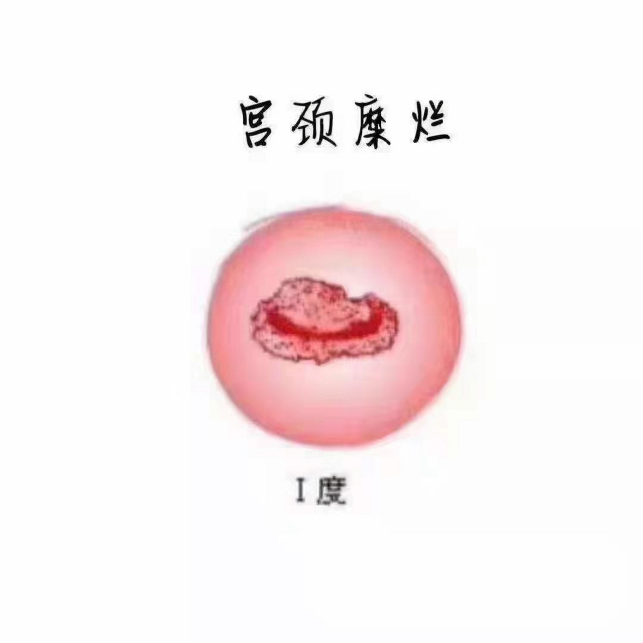 78科普:宫颈糜烂一度: 面积小于1/3,轻也不会自愈 拖延下去,只会更