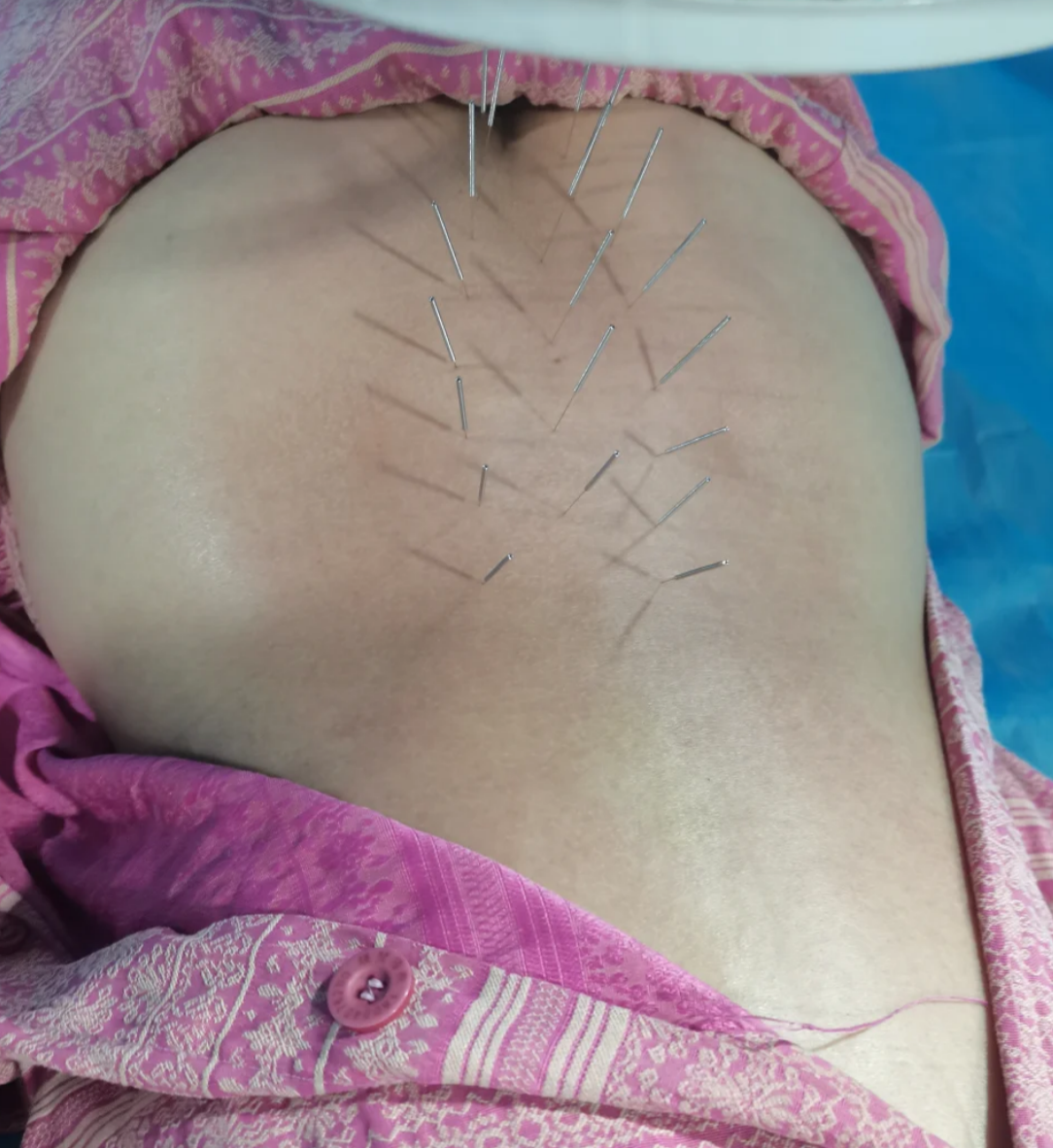 骶1隐裂的治疗方法主要根据症状来决定