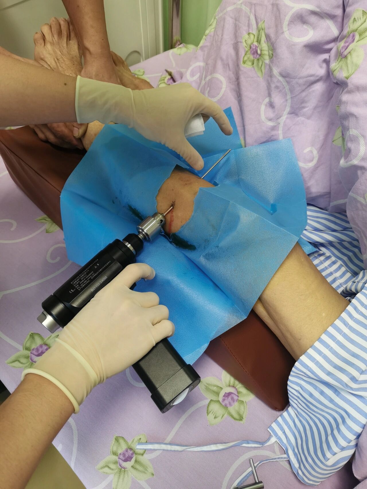 骨牵引 胫骨结节牵引进针部位 胫骨结节牵引的进针点位于:胫骨结节