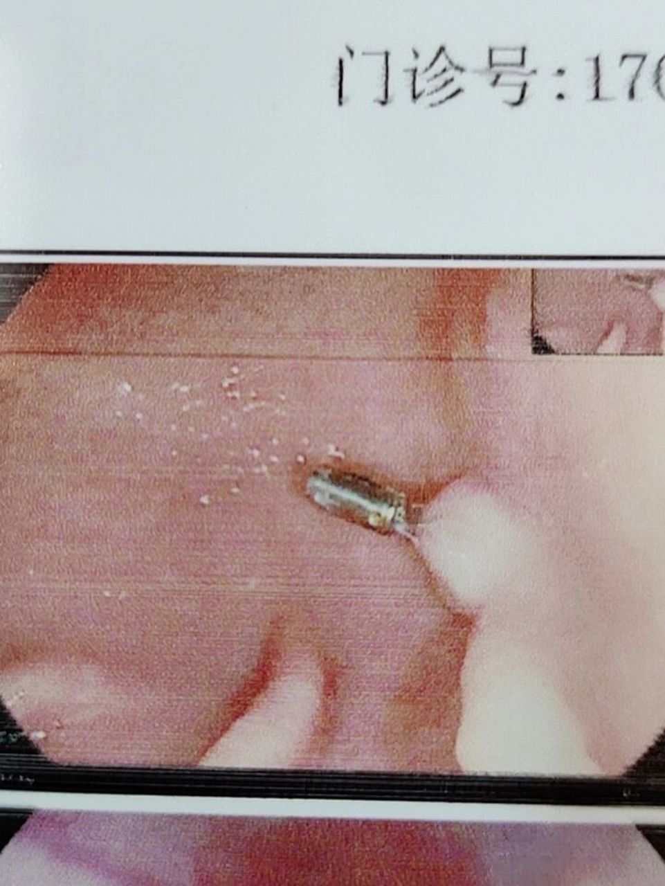 钛夹 半年前做胃息肉手术之后,留在胃里的钛夹没有掉,怎么办?