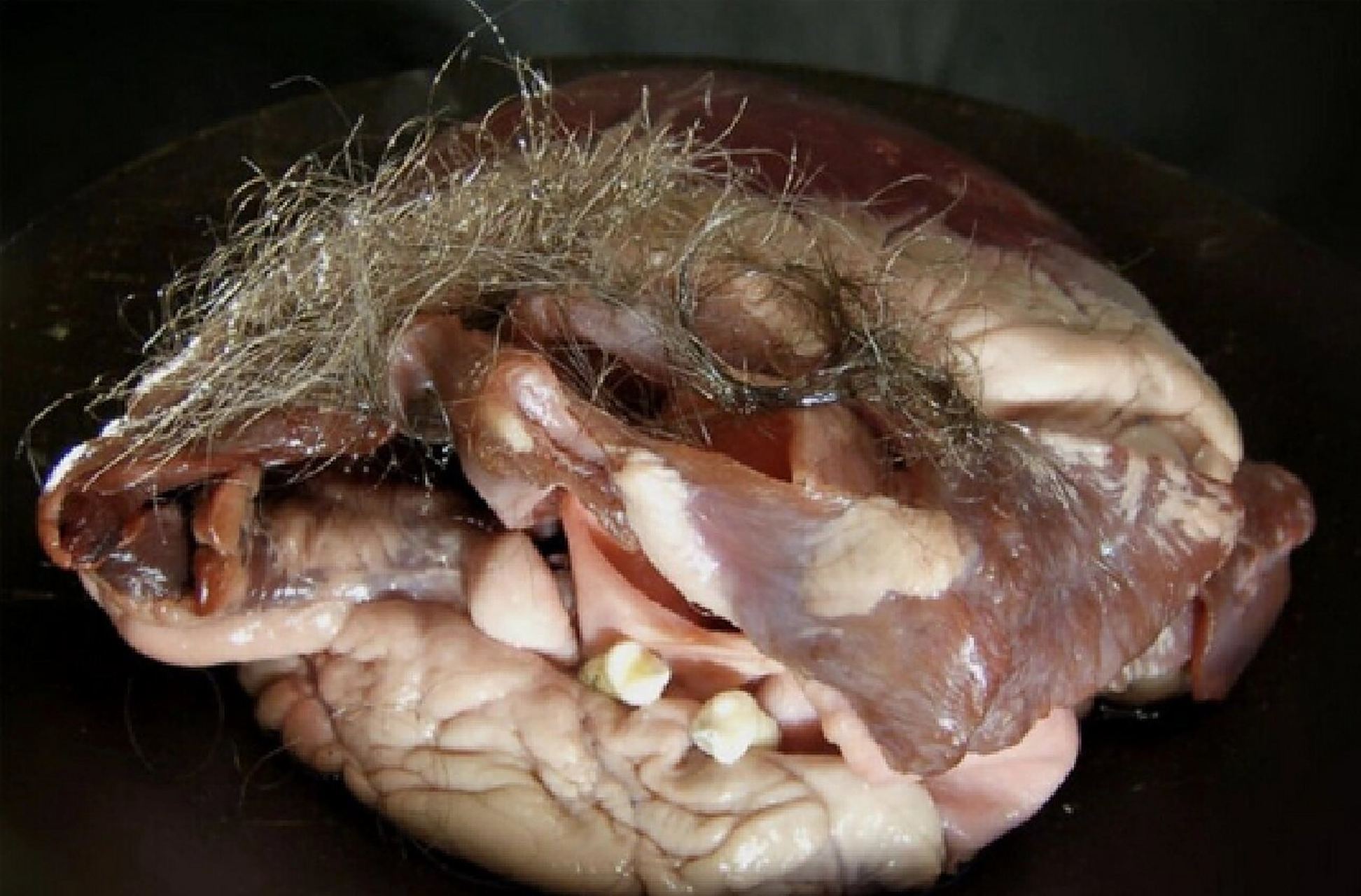 之前一直和大家说畸胎瘤这个东西,常见腔内充满毛发,有时可见牙齿.