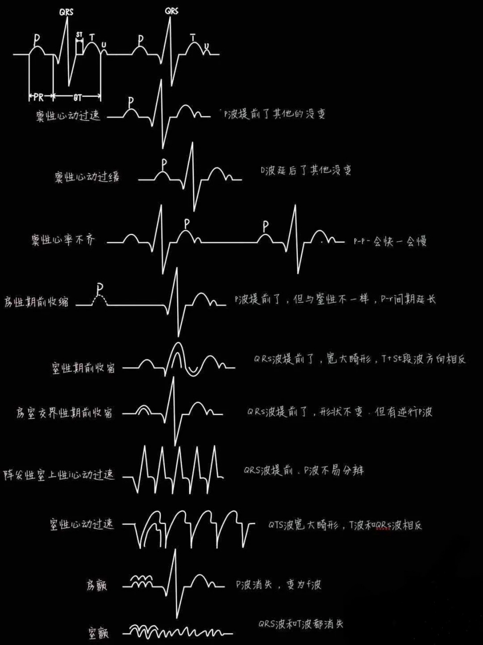 一張圖看懂心電圖 心電圖很難,希望這張圖片可以幫助到你們,讓你們更