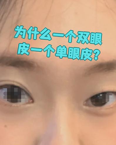 双眼皮为什么会变成单眼皮怎么变回去为什么在线