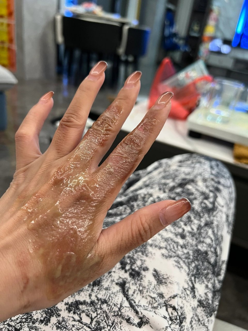 烫伤 脱皮了医生说可以下水了,然后药再薄薄上一层就好,等皮脱落就不