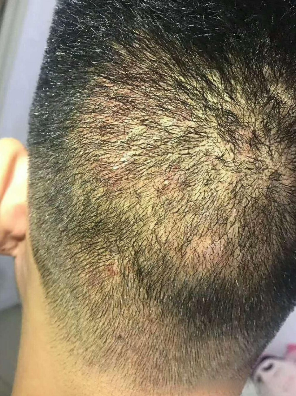 毛囊炎反反复复,痒痛难忍,中医帮你治本 头上总是长红疙瘩,碰一下就