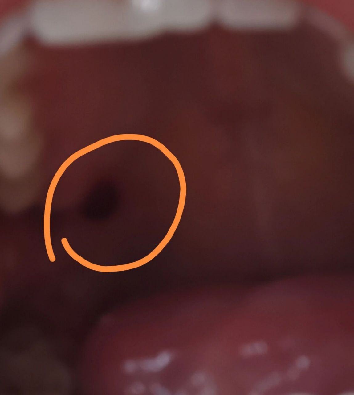 嘴里出了一个血泡 吃一块苏打饼干吃出一个大血泡