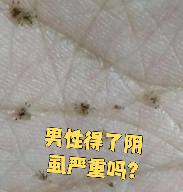 阴虱病是由阴虱虫引起的寄生虫病,传染性很强