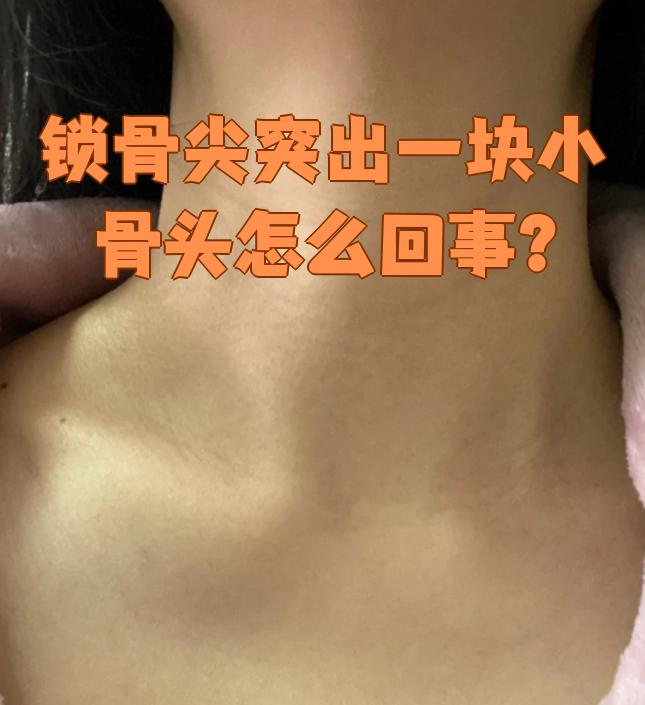 锁骨尖突出一块小骨头,这种情况一般不算正常