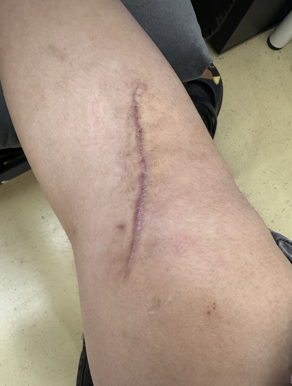 术后三月疤痕的样子,减张缝合已经平了许多,疤痕处还有些发红;建议