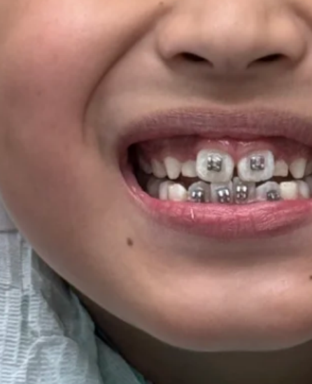 一岁宝宝牙齿长歪了不用太担心